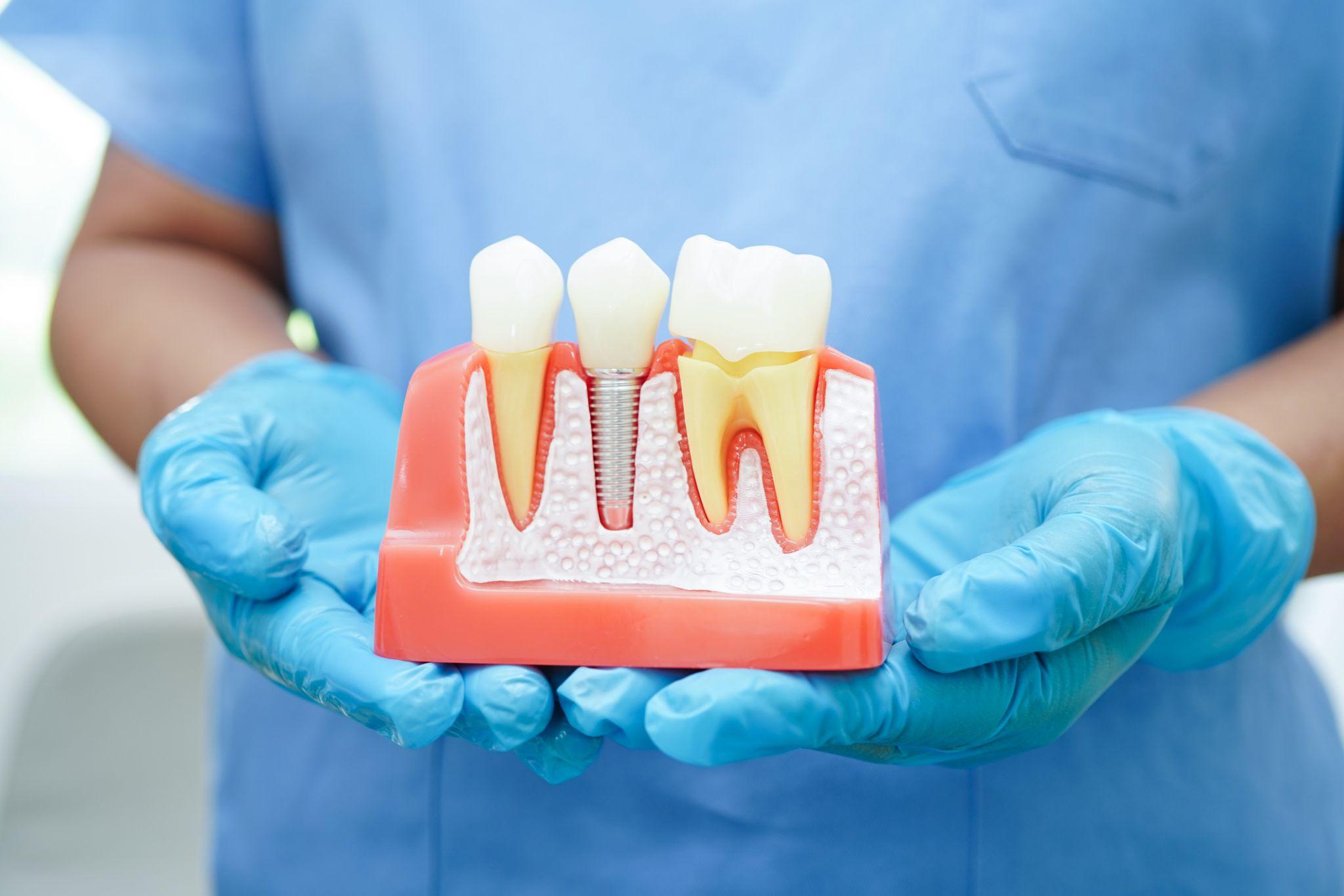 How Much Are Dental Implants