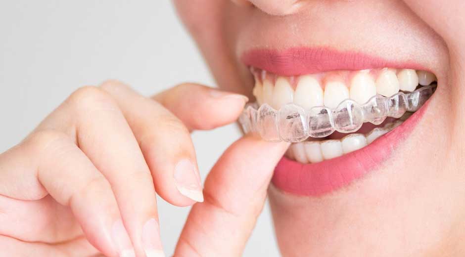 Benefits-Of-Using-Teeth-Aligners-For-Orthodontic-Correction